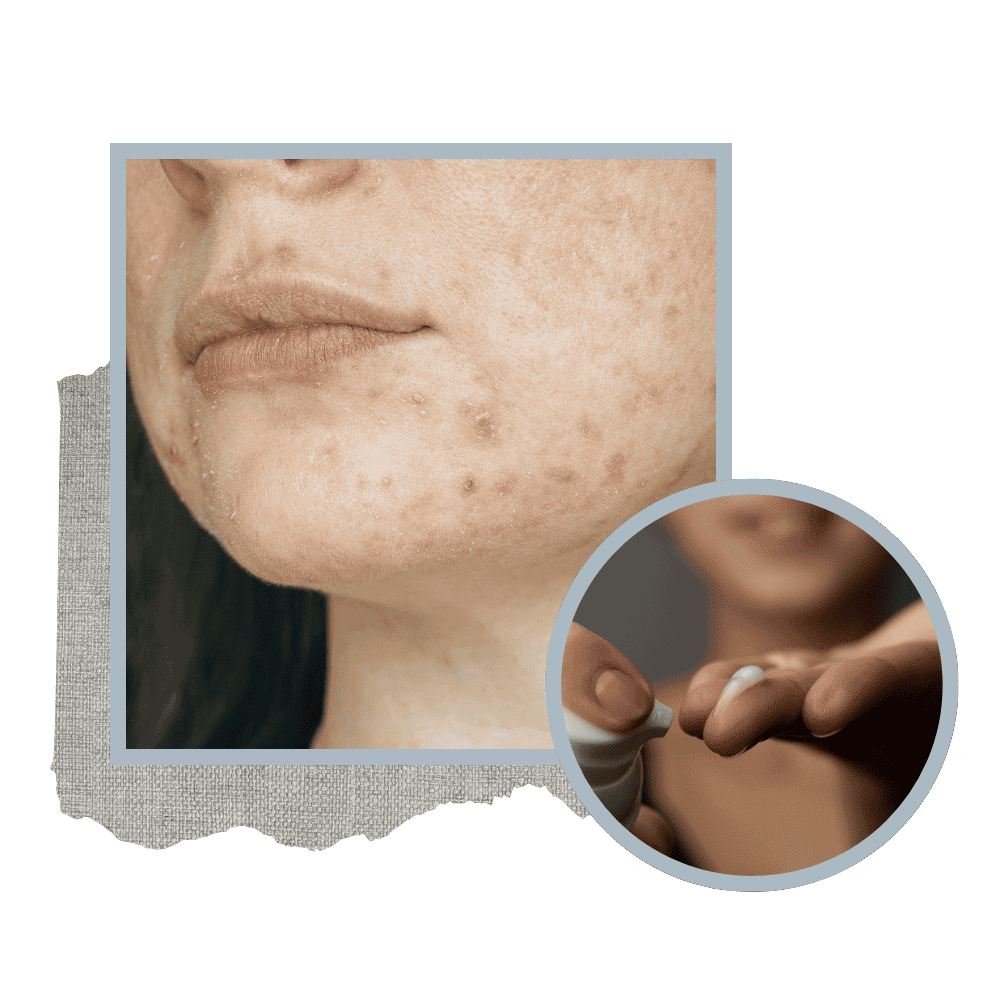 Acne prescription treatments