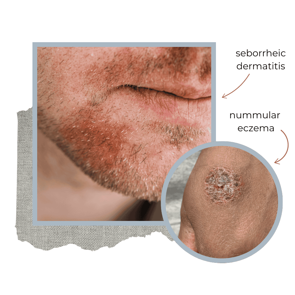 Seborrheic Dermatitis on adult male's face and nummular eczema on hand