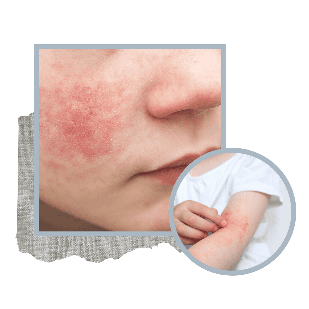 Eczema on face and elbows