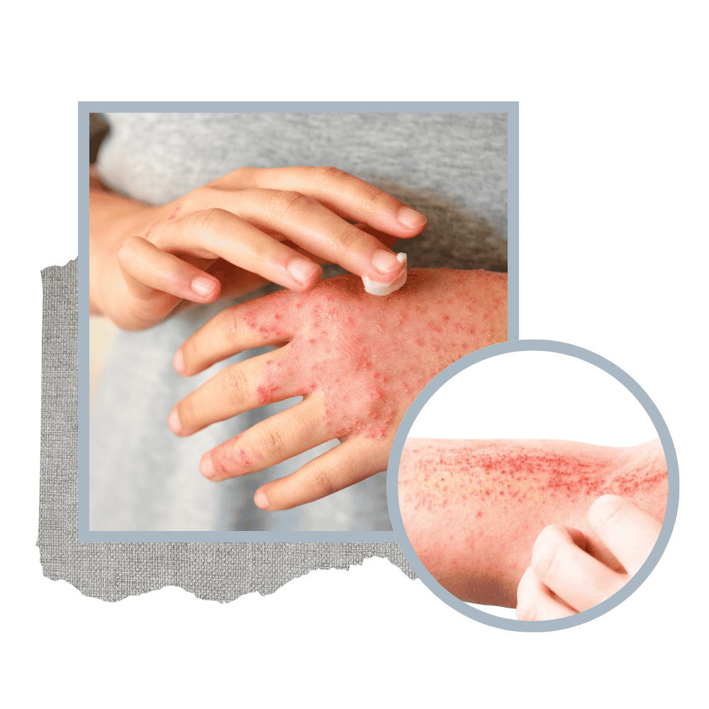 eczema on hand and elbow